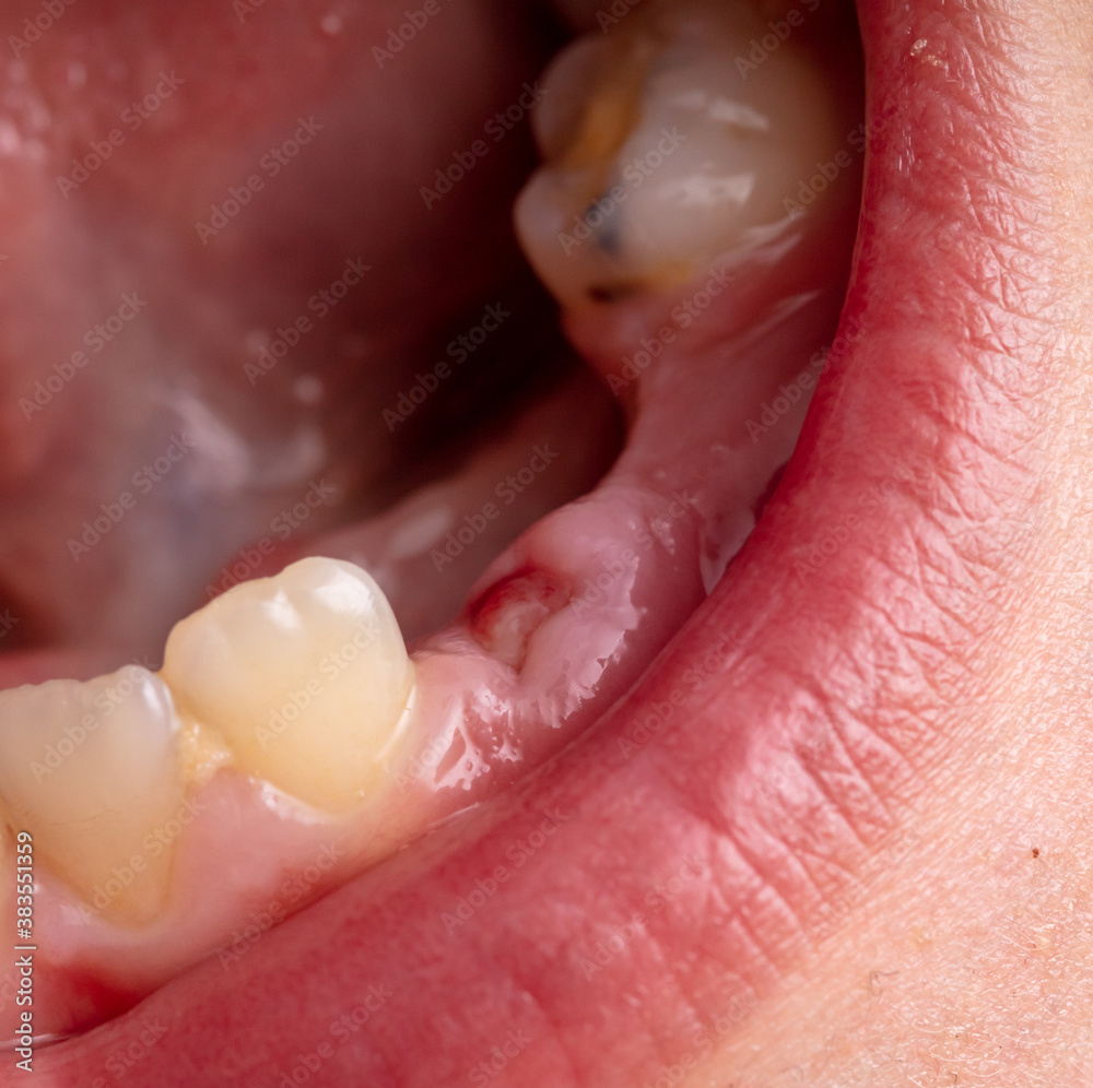 Obraz premium Close-up of a boy's milk tooth fell out.