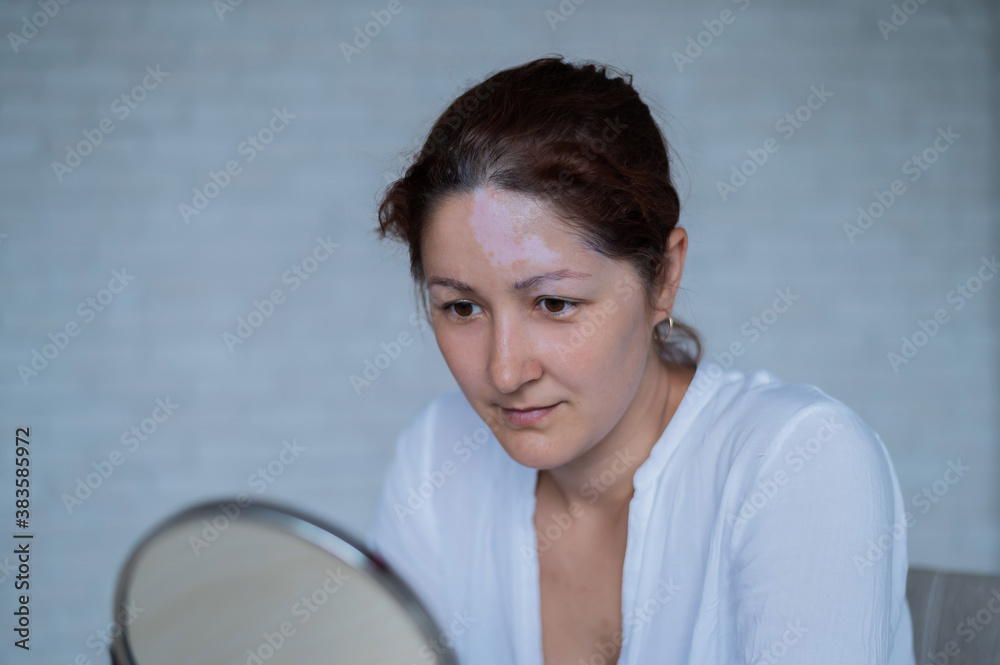 Portrait of a Caucasian woman with vitiligo. A girl with a white pigment spot on her forehead looks in the mirror. An autoimmune disease affecting the skin. Portrait of a Caucasian woman with vitiligo. A girl with a white pigment spot on her forehead looks in the mirror. An autoimmune disease affecting the skin.