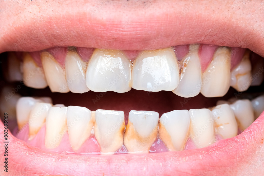Fototapeta premium Tooth's a man smoking bad. Man smokes a cigarettes have tooth decay and calculus on teeth, So we should be care dental with the hygiene