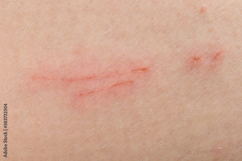 Scratch marks on skin surface cause by sharp fingernails scratching an itch, closeup macro view. Scar on a man's thigh caused by scratching on itchy skin. Healing cut wound on a person's flesh.