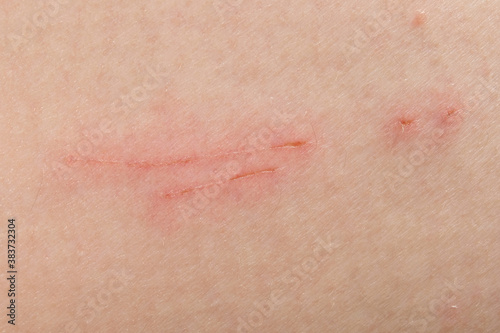 Scratch marks on skin surface cause by sharp fingernails scratching an itch, closeup macro view. Scar on a man's thigh caused by scratching on itchy skin. Healing cut wound on a person's flesh.