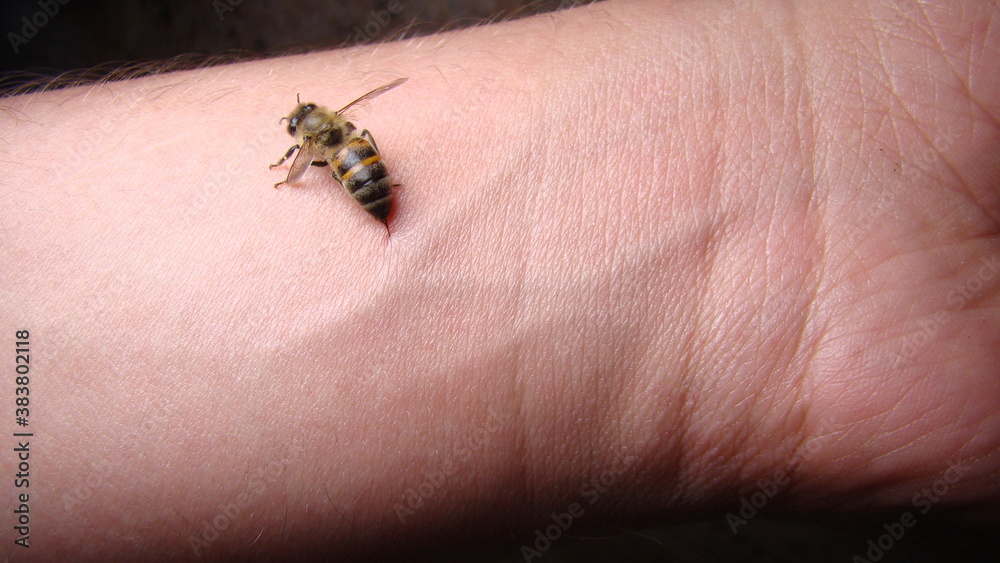 bee : apis mellifera treatment by honey bee sting closeup honey bee stinging a hand close up bee worker insects, insect, animal, wildlife, wild nature, forest, woods, garden beauty of pollination	