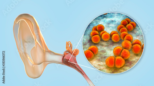 Otitis media, inflammatory disease of the middle ear