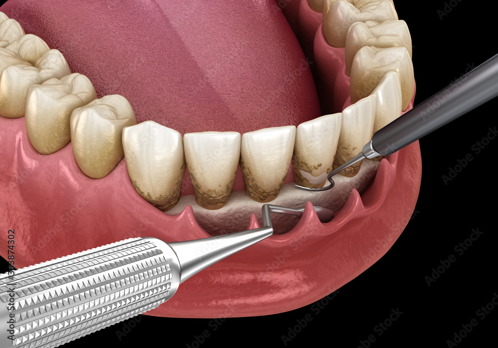 Open curettage Scaling and root planing (conventional periodontal