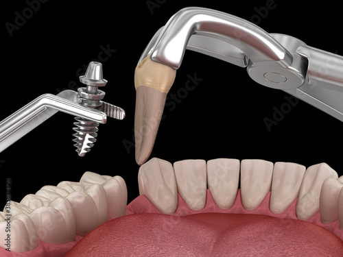 Extraction and Implantation, complex immediate surgery. Medically accurate 3D illustration of dental treatment