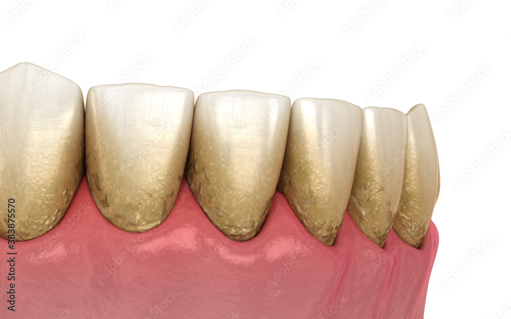 Tartar and bactrail tooth plaque, lower jaw. Medically accurate 3D