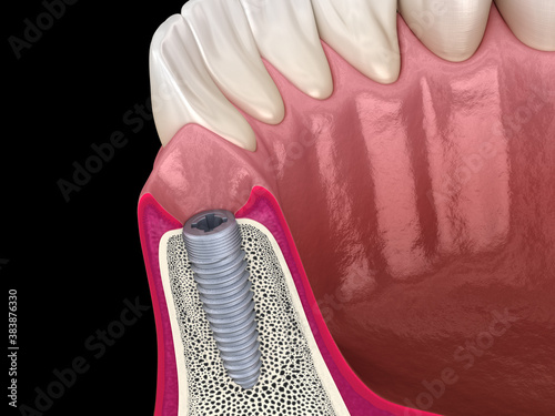 Instaled dental implantat. Medically accurate tooth 3D illustration. photo