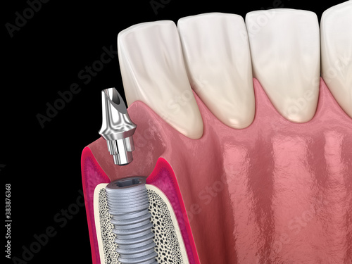 Standard abutment, dental implant and ceramic crown. Medically accurate tooth 3D illustration.