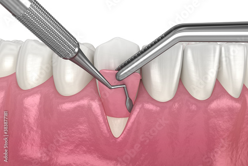 Fotografie Gum Recession: Soft tissue graft surgery