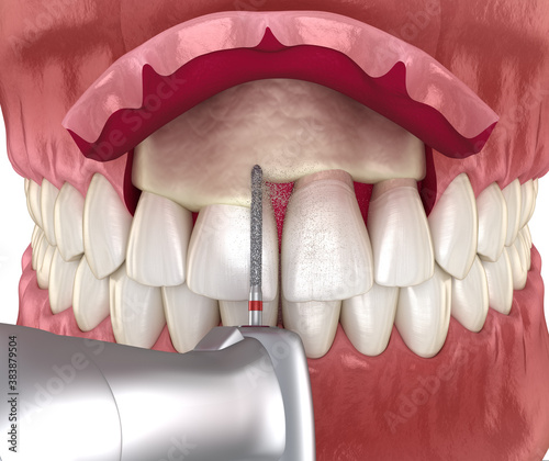 Frontal crown lengthening, Esthetic surgery. Medically accurate dental 3D illustration photo