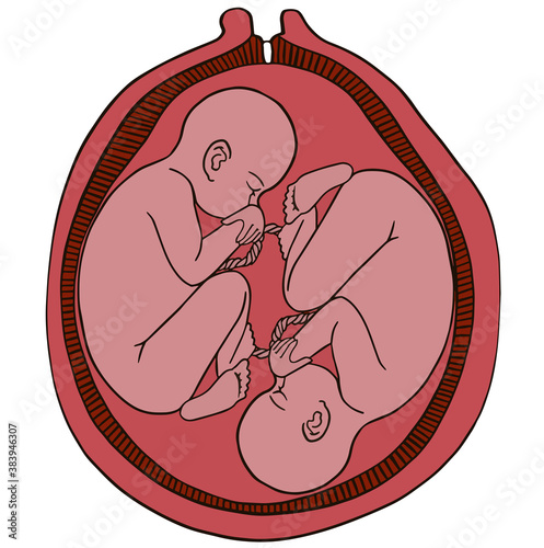 Human twins fetus concept hand drawn vector illustration prenatal growing baby, umbilicle cord Vector icon. For cards, posters, coloring book,for scientific journals book illustrations