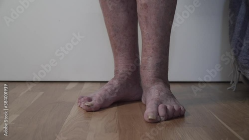 Sick elderly leg. Senior leg problems. Legs old woman with crippled nails. Toenail fungus on senior female toes close up. Unkempt crone toenails. Calluses and sores on legs. Pain and discomfort feet