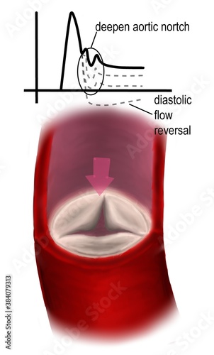 arotic regurgitation and flow waveform photo