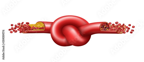 Vein with cholesterol and blood clot tied in a knot. Vector illustration