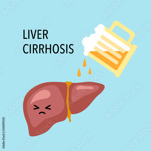 Drinking beer or alcohol beverage can damage liver. Liver cirrhosis disease vector illustration. Healthcare concept.