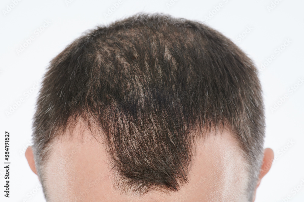 Man losing hair on head Man losing hair on head
