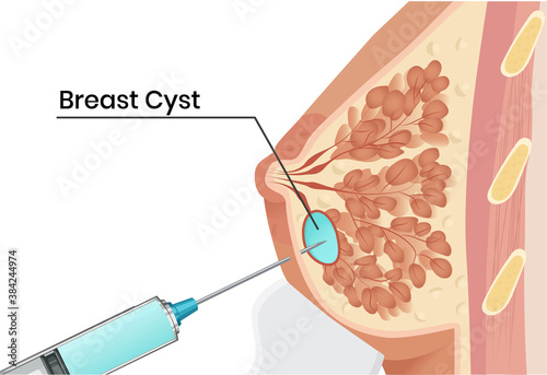 Breast cyst aspiration under the ultrasound guidence