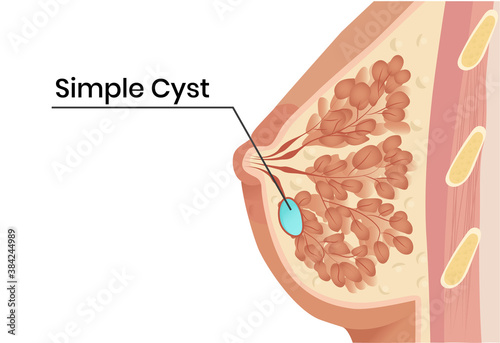 Simple breast cyst anatomy illustration