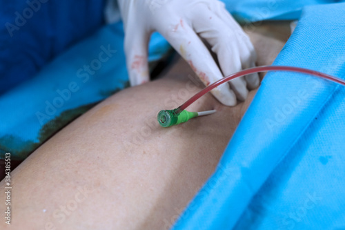 Scrub nurse press at puncture site of patient’s groin. Focus at introducer sheath. photo