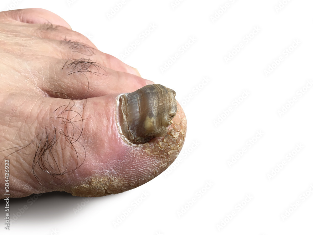 A fungal infection of the nail plate, Onychomycosis, Tinea Unguium Stock  Photo