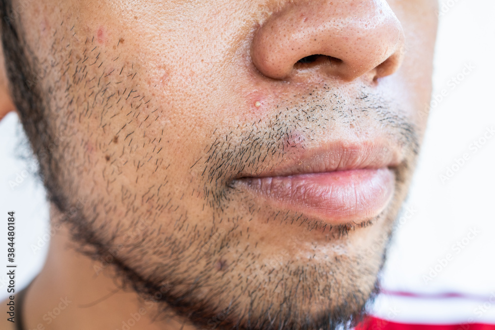 Obraz premium Close-up shot of a whitehead acne occur on men's skin. A whitehead is a type of acne that forms when oil, and bacteria become trapped within one of your pores.