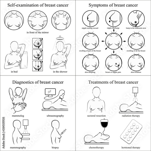 Breast cancer set. Self-examination, symptoms, diagnostics, treatments. Medicine, pathology, anatomy, physiology, health. Info-graphic. Vector illustration. Healthcare poster or banner template.