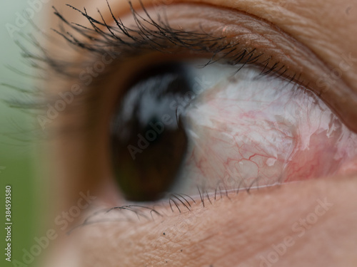 the women have a  Pinguecula in her eye