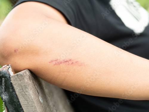 close up abrasions on the arm 