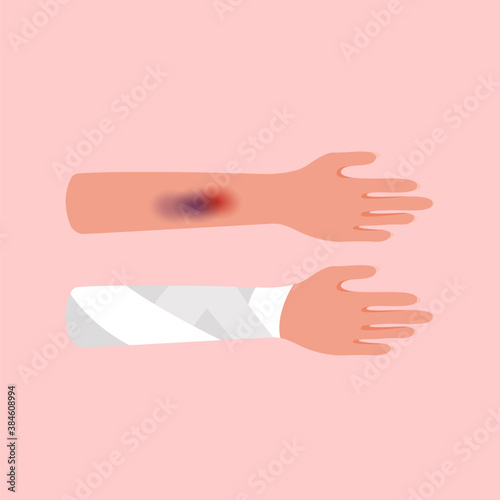 Severe injury or bruise on the arm. Elastic bandage or bandage on persons hand