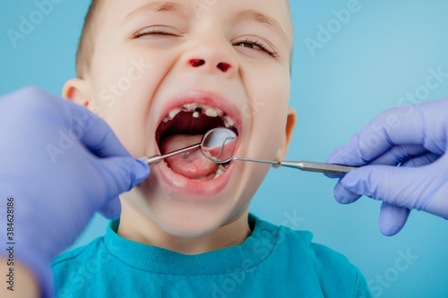 Close up of dentist's hands with assistant in blue gloves are treating teeth to a child, patient's face is closed