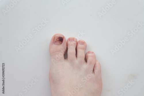  Toenails damaged by hematoma. Detachment of the nail, blow to the nail. Ingrown nail. Nail care concept