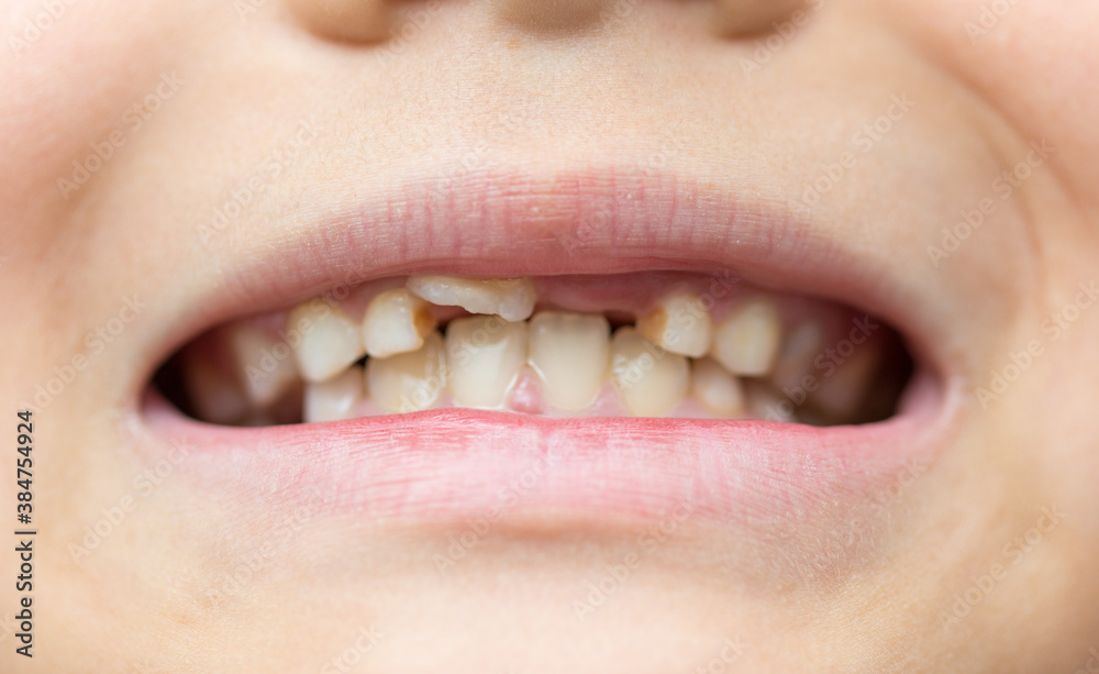 Obraz premium Boy portrait, bad teeth, close-up.