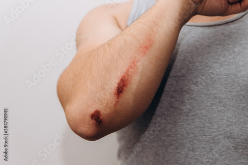 Large abrasions on the forearm of a man after a fall.