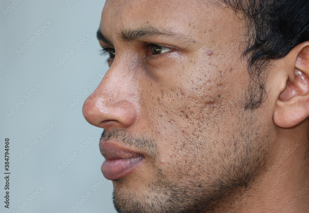 Close up of problematic skin with deep acne scars on cheek of a man