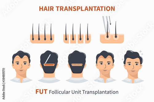 Stages of hair transplantation FUT Follicular Unit. Treatment surgery of baldness, alopecia, mens hair loss. Vector medical infographics, a male head scalp. Strip, graft machine.