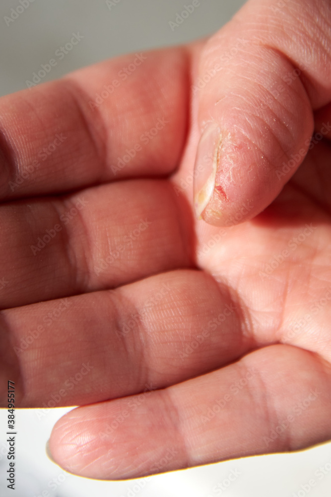 Cracked and dry skin on a woman's thumb, close-up. Cracked and dry skin on a woman's thumb, close-up.