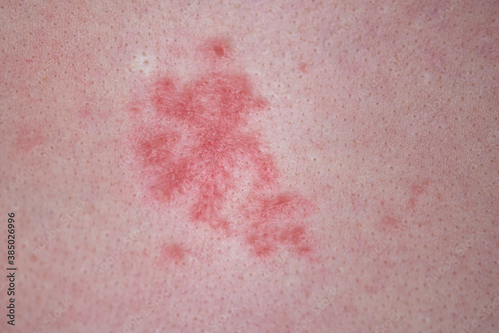 Human skin with red allergic spots, sores