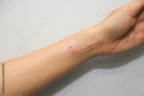 skin allergies, Arms and wrists skin women. photo