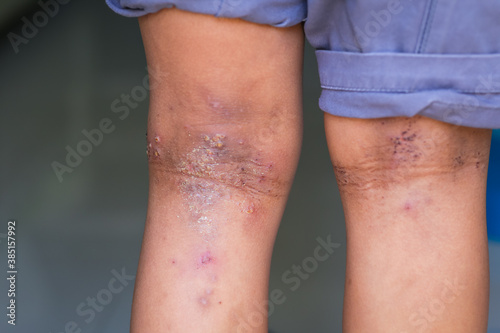 Принти на полотні Close up on eczema, skin rash, atopic dermatitis on a boy's legs.