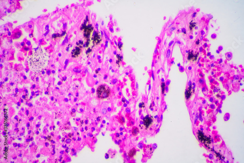 Viral pneumonia disease human cells photo