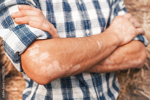 The manifestation of vitiligo disease on the skin of a man's hands