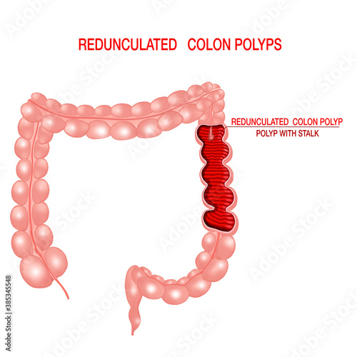 Colon polyp. Polyp in the intestine .Medicine Anatomy .Colon pathologies.