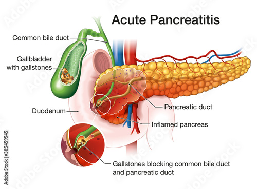 Acute pancreatitis, medically illustration photo