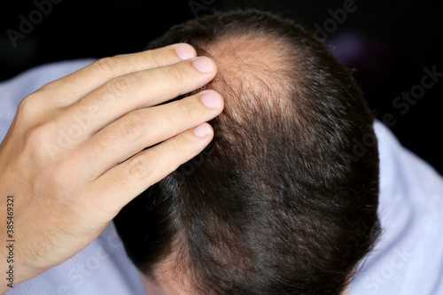 Baldness, man concerned about hair loss. Male head with a bald