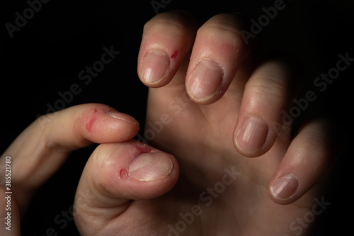 Dermatophagia disorder shown on Caucasian woman's hand close up shot isolated on black