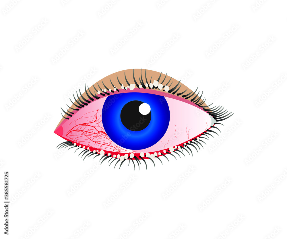 Sore eyes, inflamed reddened eyes, red eyes icon. Vector illustration Sore eyes, inflamed reddened eyes, red eyes icon. Vector illustration