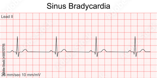 Electrocardiogram show Sinus bradycardia pattern. Cardiac fibrillation. Heart beat. CPR. ECG. EKG. Vital sign. Life support. Defib. Emergency. Medical healthcare symbol. photo