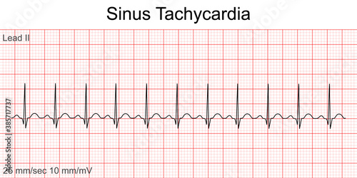 Electrocardiogram show Sinus tachycardia pattern. Cardiac fibrillation. Heart beat. CPR. ECG. EKG. Vital sign. Life support. Defib. Emergency. Medical healthcare symbol.