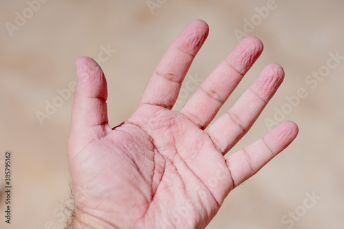 A man shocked with wrinkly and pruney skin of his hands after the bath, or being in water