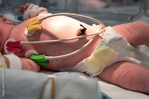 Newborn baby in the incubator with ecg electrodes, selective focus. Neonatal intensive care unit.